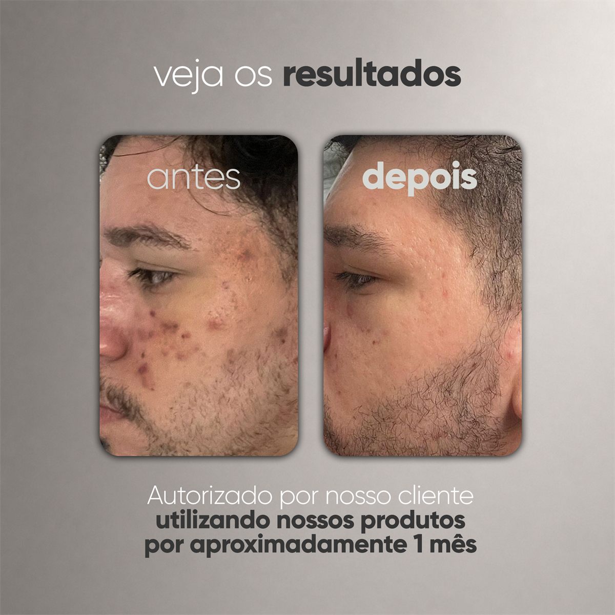 ANTIACNE - Gel Creme Antiacne - 30g — foto 6