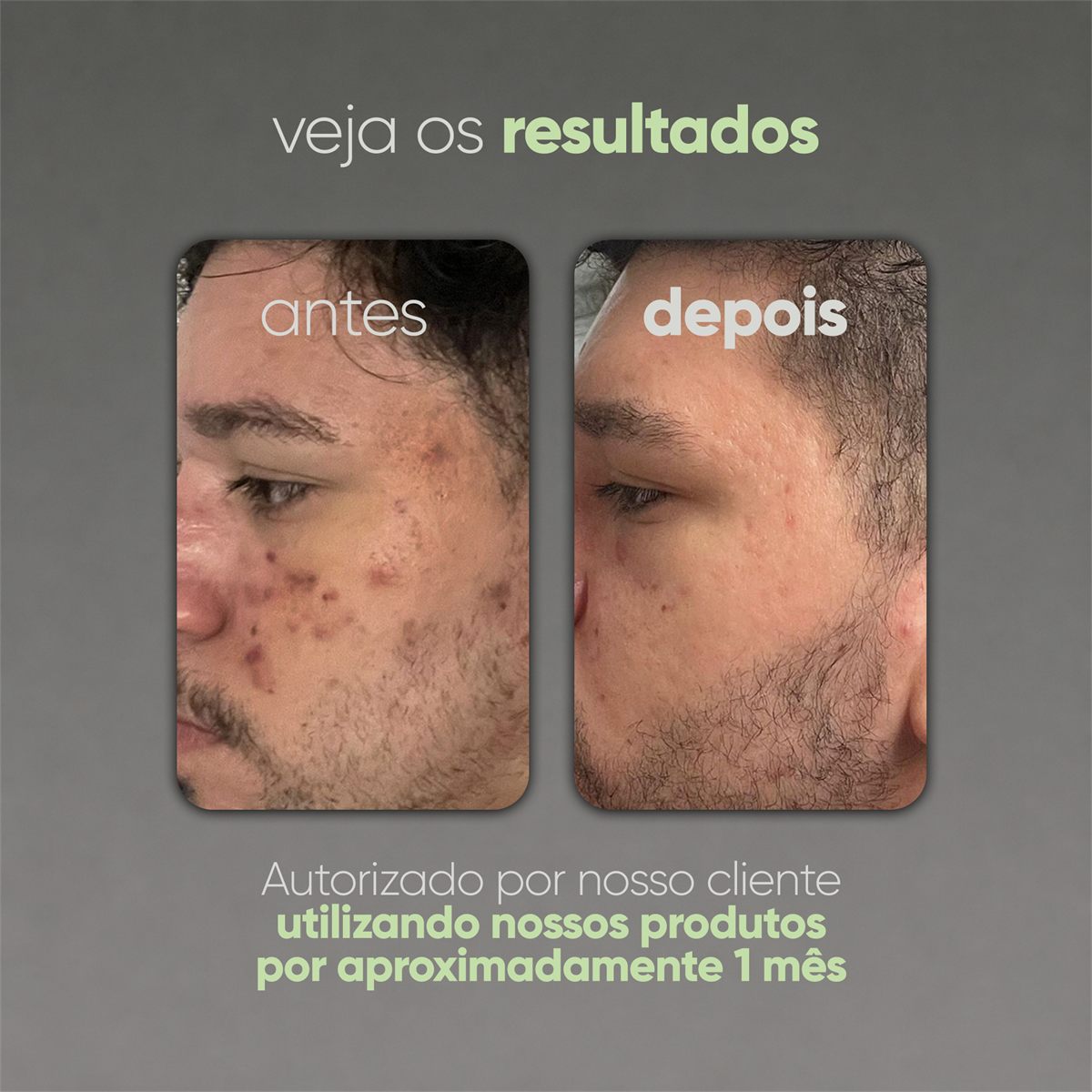 LIMPA ANTIACNE - Gel de Limpeza Antiacne Facial - 65g — foto 6